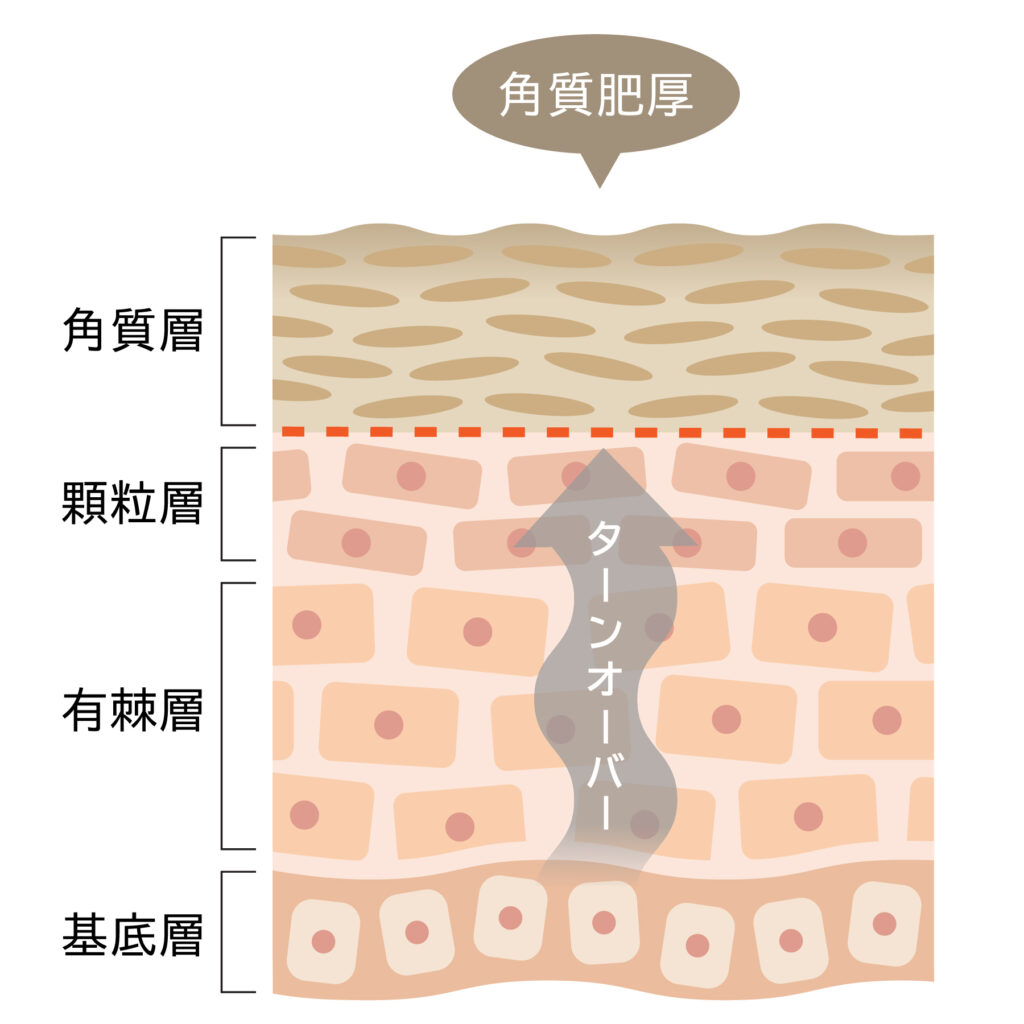 ターンオーバー