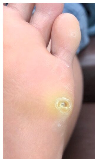 硬性鶏眼