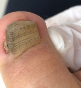 巻き爪の手術後正常な爪が生えなくなってしまった。