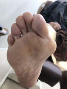 甲の筋肉が固まっているあし
