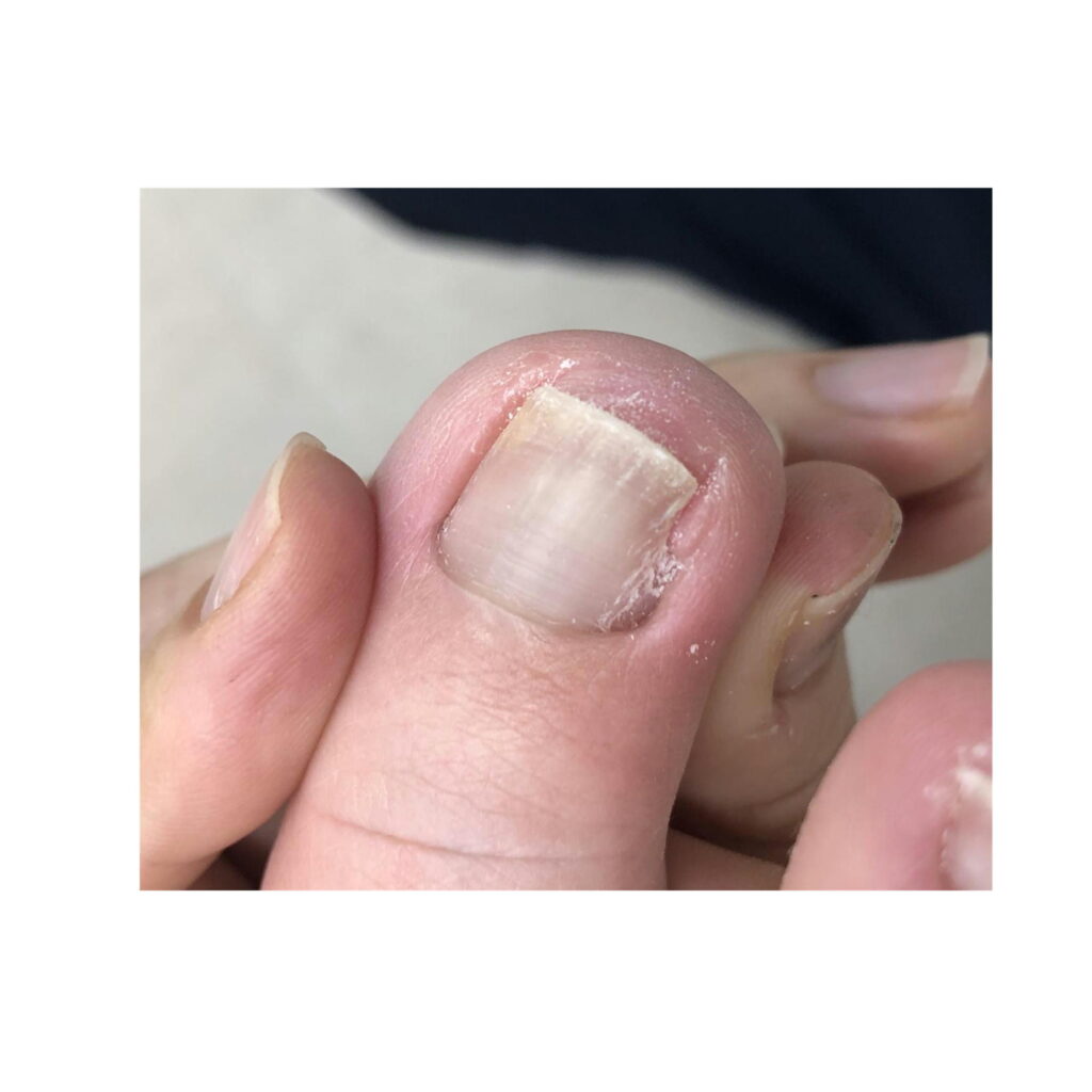刺し爪