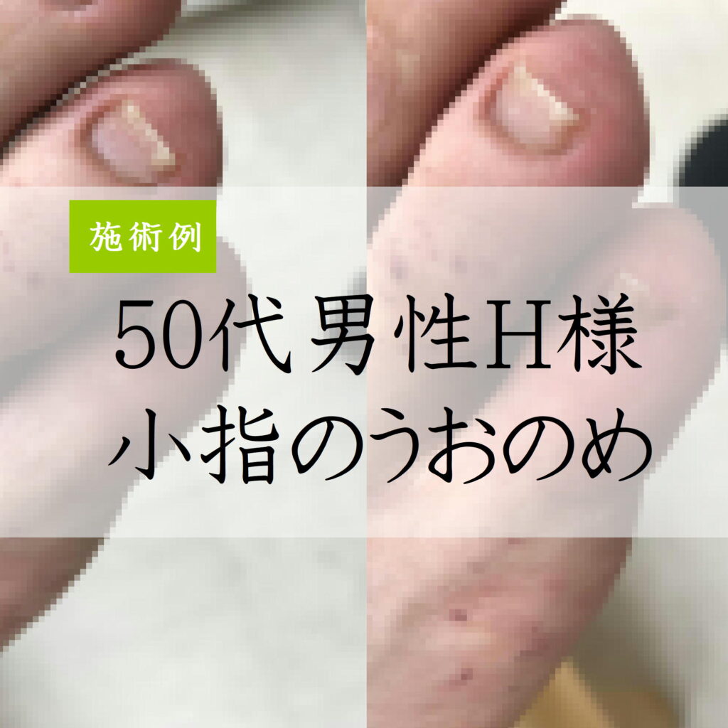 50代男性爪溝鶏眼