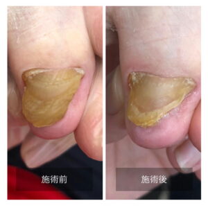 爪白癬