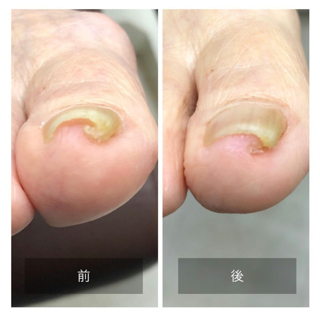巻き爪カット