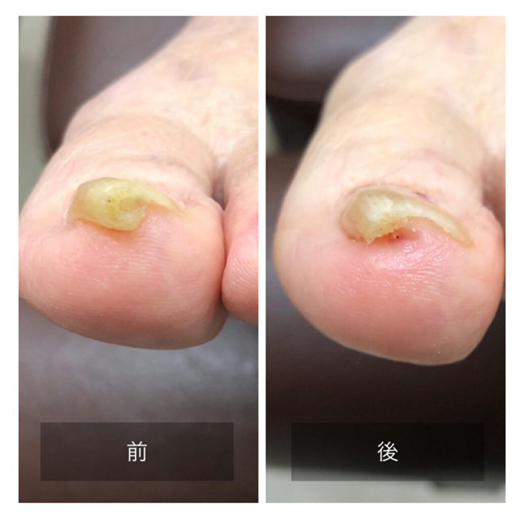 右足の巻き爪カット