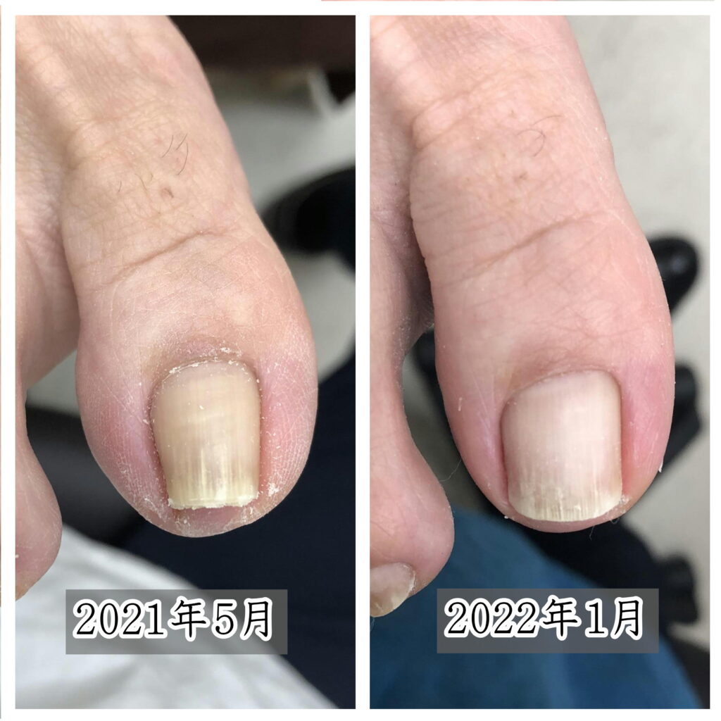巻き爪矯正