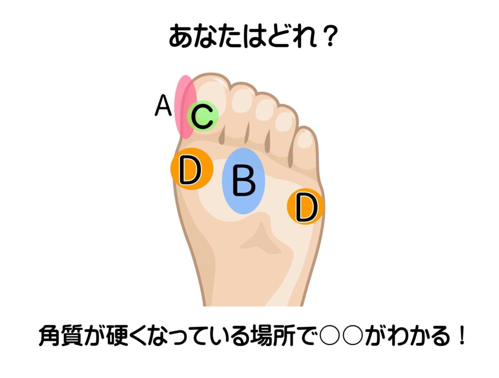 角質