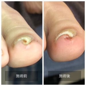 巻き爪の手術をした後、再発した方