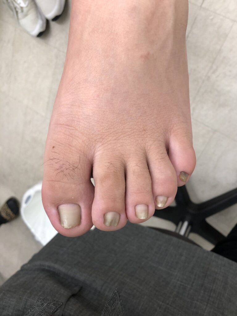 巻き爪かつ陥入爪