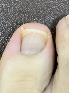 巻き爪切り方スクエアオフ