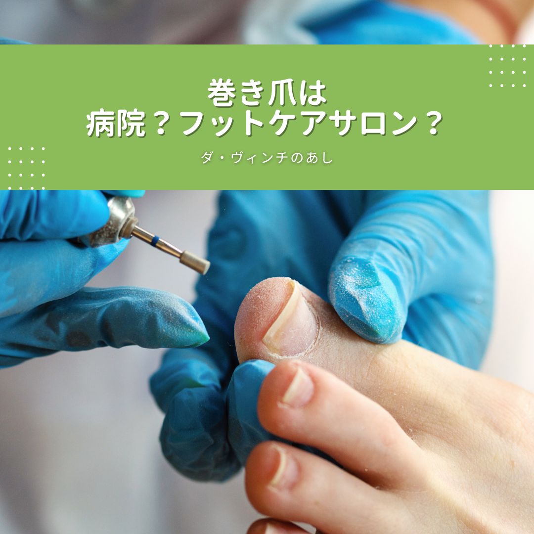 巻き爪 何科