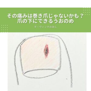 巻き爪、治し方、痛い、皮膚科、何科、自分で