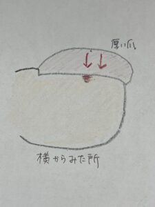 痛い巻き爪・肥厚爪・分厚い爪
