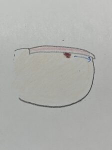 痛い爪・巻き爪・治療・分厚い